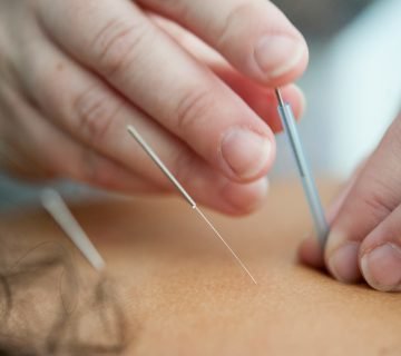 De voordelen van cosmetische acupunctuur voor huidverjonging